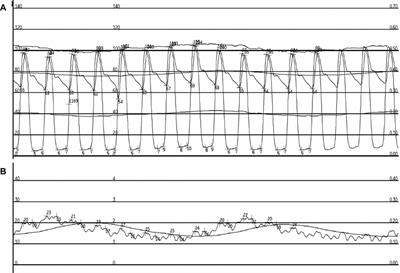 Case Report: Correlation between pulmonary capillary wedge pressure and left-ventricular diastolic pressure during treatment with veno-arterial extracorporeal membrane oxygenation